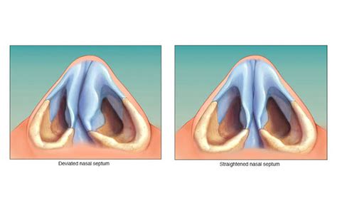 Best Septoplasty treatment in Gurgaon | Septoplasty doctor in Gurgaon