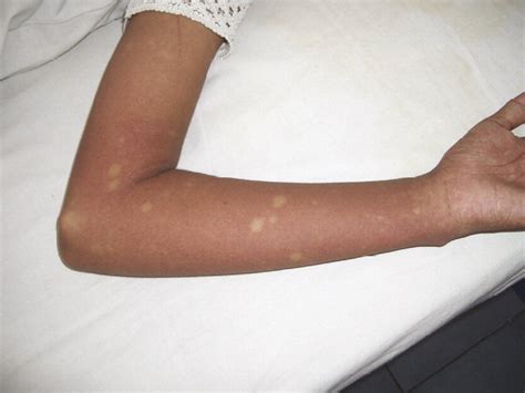 dengue fever  travellers  challenge  european physicians