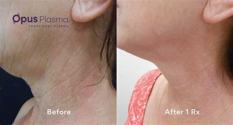 OPUS Plasma Skin Resurfacing | Edmonton | Nakatsui Derm