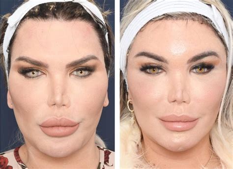 Cirurgia Plástica Rosto Antes E Depois - Cirurgia Plastica Antes E Depois Do Rosto O Que Lindsay Lohan Fez No