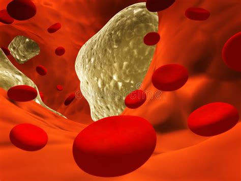 Atherosclerosis stock illustration. Illustration of human - 17504304