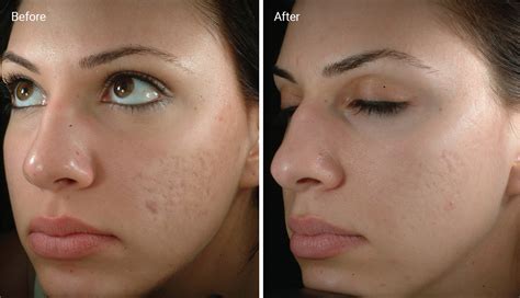 Microdermabrasion for Acne Scars: How It Works, Benefits, Efficacy & Cost