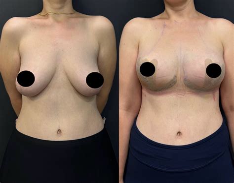 Understanding Bottoming Out After Breast Lift Surgery