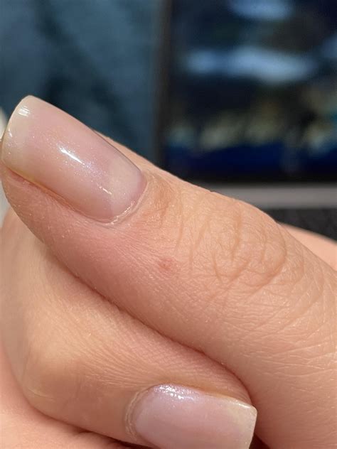 Microsurgery with non-dominant hand : r/Warts