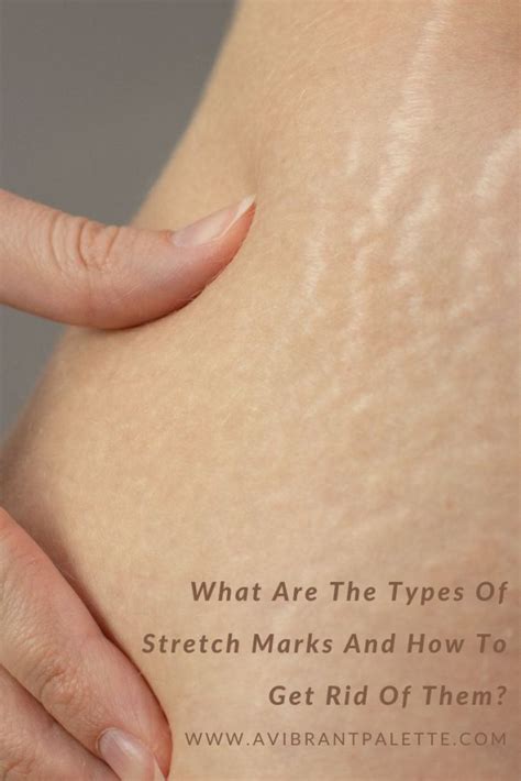 types  stretch marks     rid