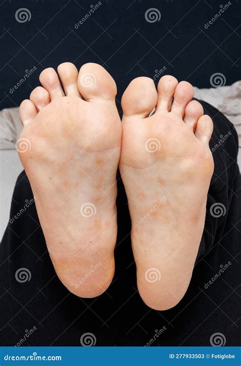 Dyshidrotic Eczema on the Sole of Female Feet Stock Image - Image of ...