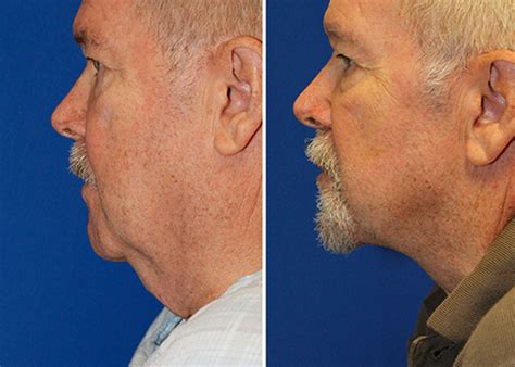 Z Plasty Turkey Neck Grecian Urn Necklift To Treat Turkey Gobbler Neck