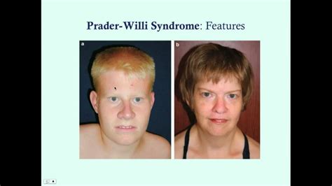 Prader Willi Syndrome
