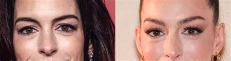 Did Anne Hathaway Really Have a Facelift? Experts Reveal the Subtle