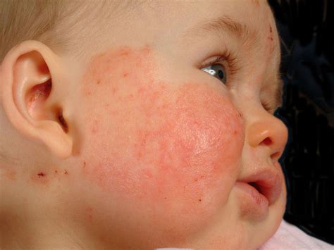 What Is Seborrheic Dermatitis? Eddie's Happy Cappy, 55% OFF