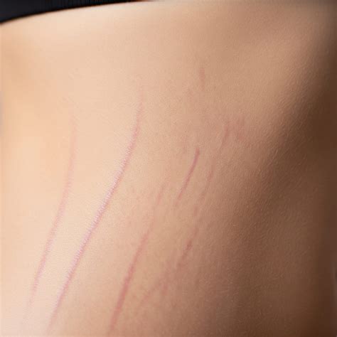 how to remove stretch mark 2