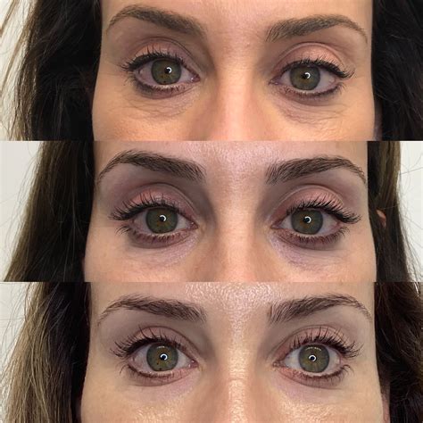 RF Microneedling in San Diego