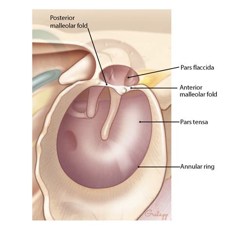 Tympanic Membrane Perforation Repair