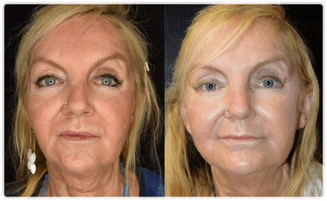Thread Lift – Face Lift procedures in Toronto & Mississauga | Lip Doctor