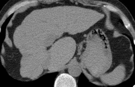 Анатомия Печени — 24Radiology.ru
