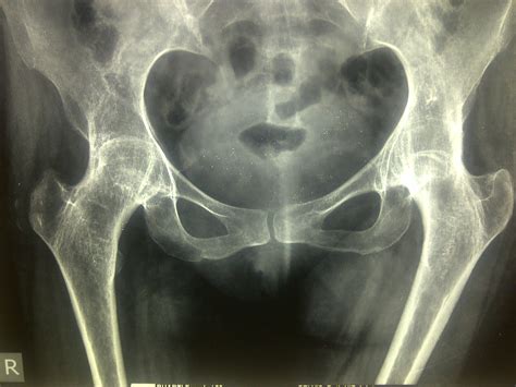 THR-Primary Total HIP Replacement – Dr. Girish Dewnany