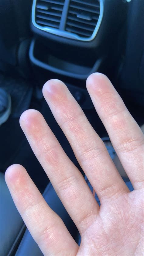 Fingertips Bruised? Swollen? : r/medicalmysteries