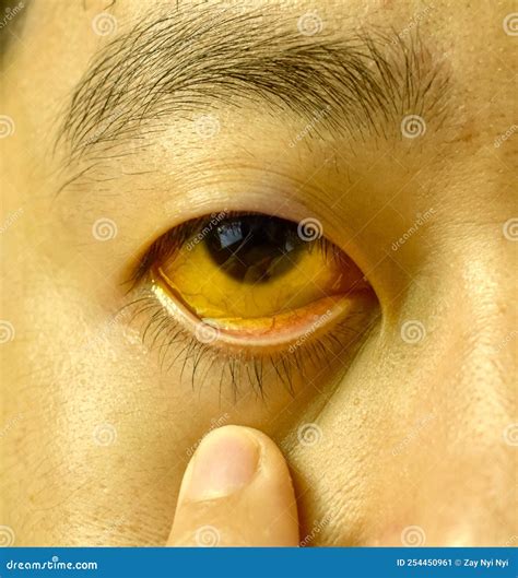 Deep Jaundice of Eye in Asian Male Patient. Yellowish Discoloration of