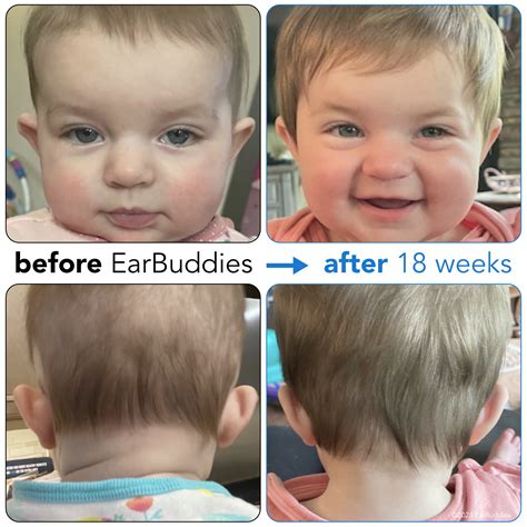 Before & Afters | EarBuddies™ | Permanent Solution to Stick Out Ears