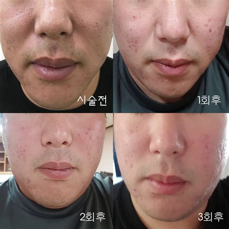 피부 여드름 흉터, 프락셀로는 효과 못보다 겨우 치료한 후기 - 겨울애상