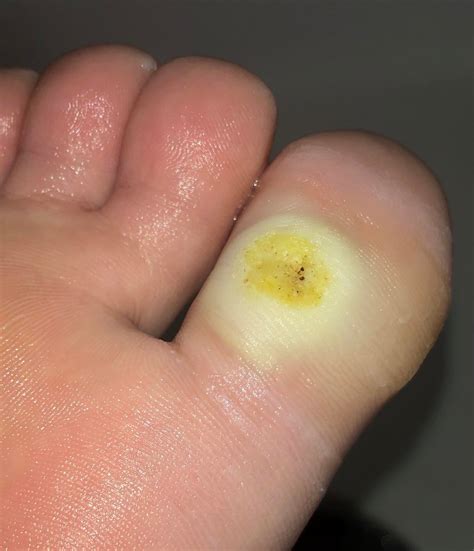Plantar Wart Treatment | Plantar Warts And Callus – YDRFM