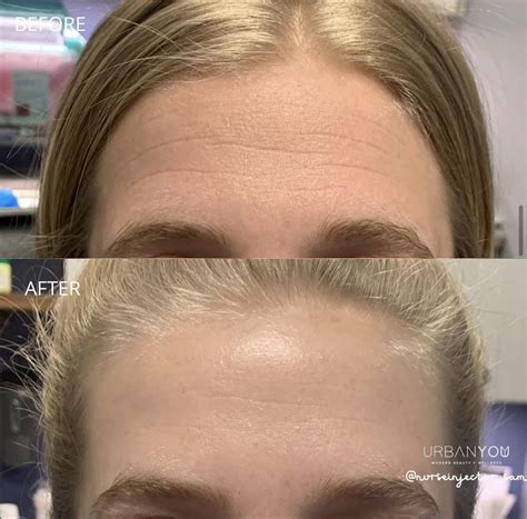 Areas of Botox: The Complete List — Urban You Med Spa