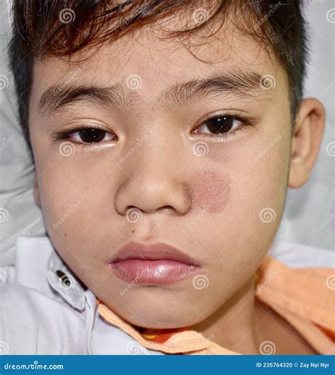 Fungal Infection On Face After Kissing at Brain Gregory blog