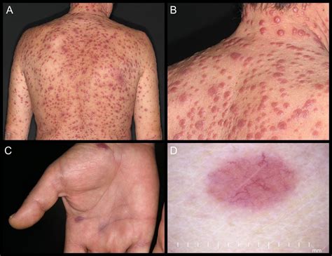 syphilis lesions   infoupdateorg