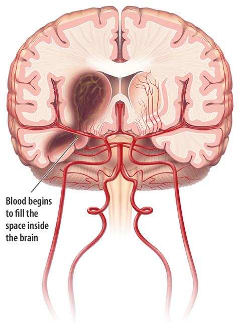 Parenchymal Hemorrhage
