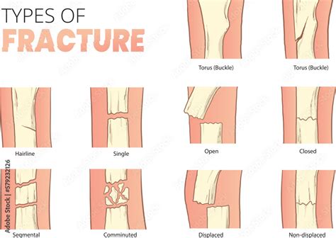types  bones fracture stock vector adobe stock