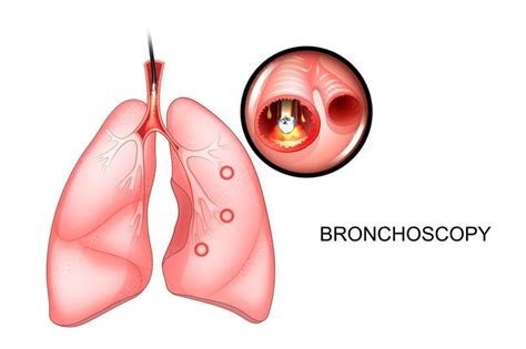 Lung Cancer Diagnosis | Diagnosing Lung Cancer