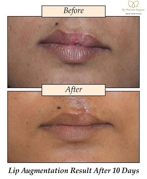 cleft lip   physical split  separation    sides