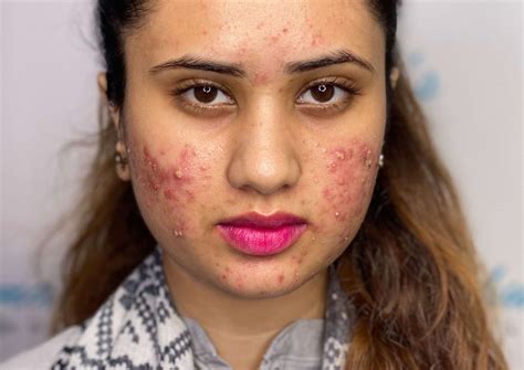 acne scars acne treatment acne scar treatment shumailas