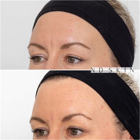 Glabellar Filler Gallery - ND Skin - Before and Afters