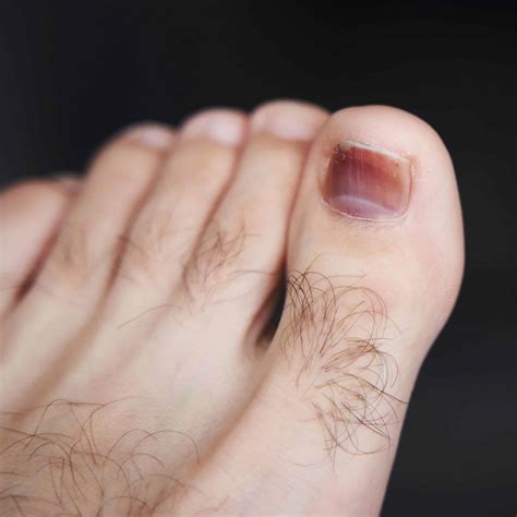 เล็บเท้าห้อเลือด รักษาอย่างไร ต้องถอดเล็บไหม ทำยังไงถึงจะหายปวด