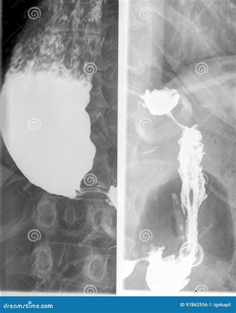 Gastroesofageal Examination Xray Barrium Swallow Stock Photo - Image of