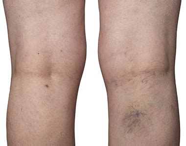 deep vein thrombosis arm picturesukraine