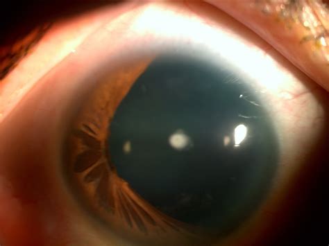 Aniridia