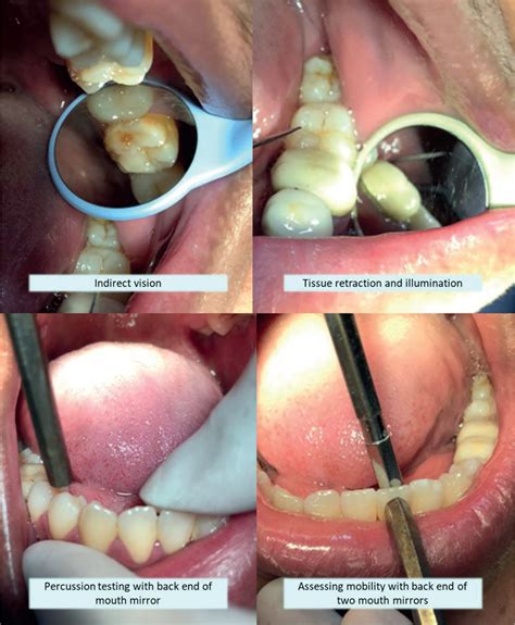 Dental Update - Technique Tips: A Reflection on Mouth Mirrors: Types