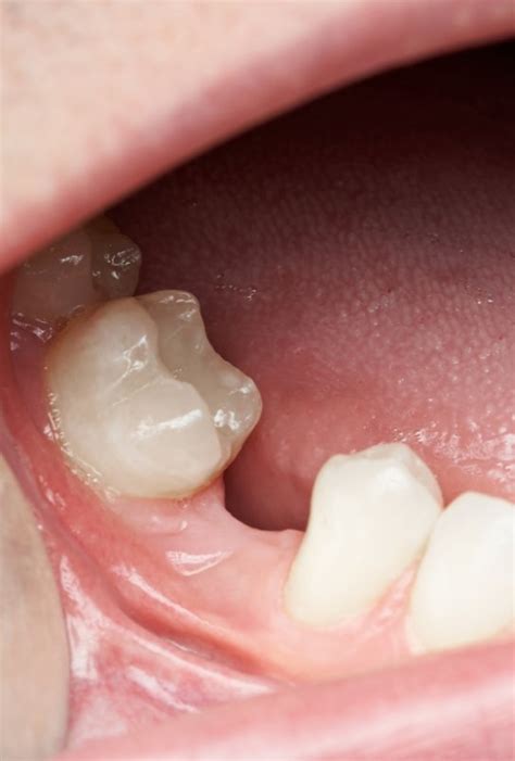 replace missing teeth federal  wa dental implants dentures