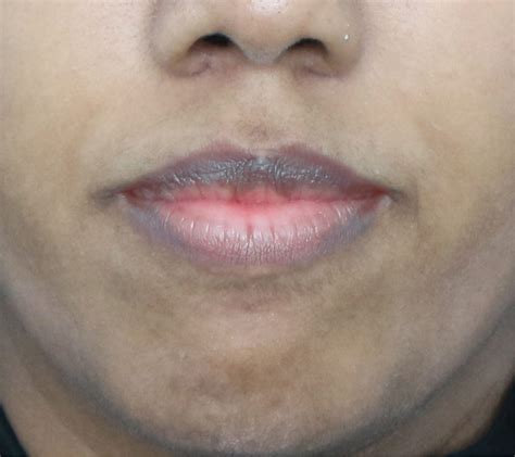 Pink Lips Treatment - Aesthetic Clinic Malaysia