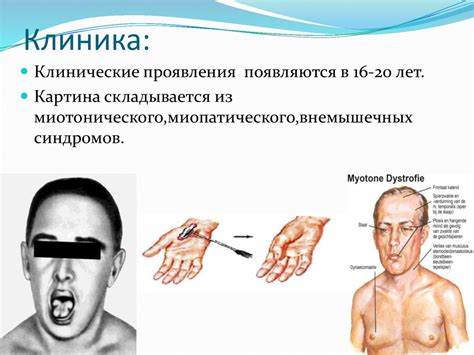 Миотоническая дистрофия Россолимо-Штейнерта-Куршманна-Баттена ...