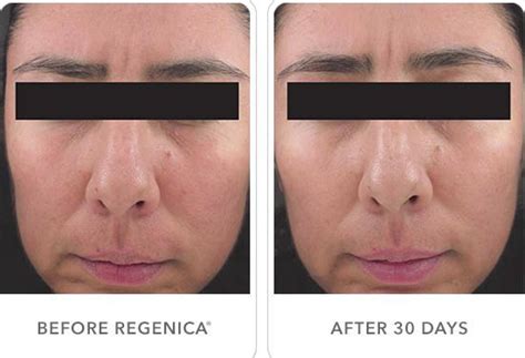 Before and After #Regenica Use! | Age defying skin care, Skin medica, Skin rejuvenation