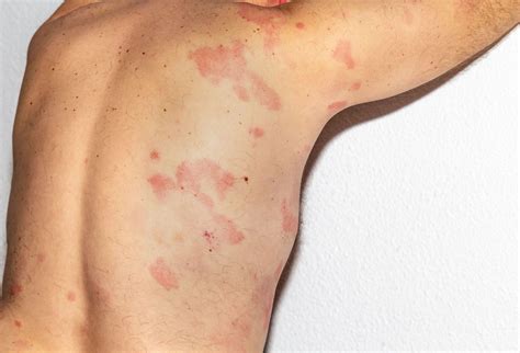 Rash Caused by Lamictal May Be a Sign of Drug Induced Hypersensitivity ...