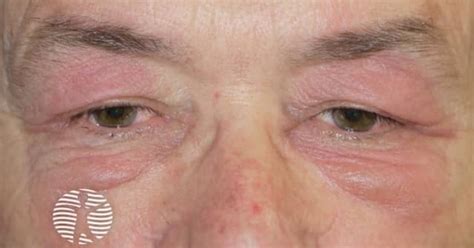Dermatomyositis of eyelids image