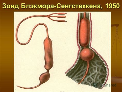 Презентация на тему: "Синдром Синдром портальной гипертензии ...