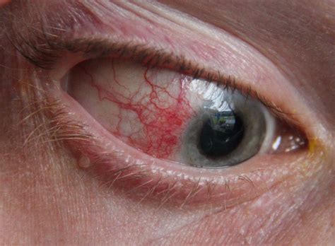Episcleritis | Causes, Symptoms, and Personalized Risk Calculator