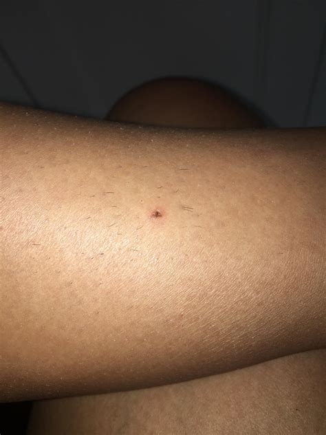 I found this on my lower calf should I be worried : r/skincancer