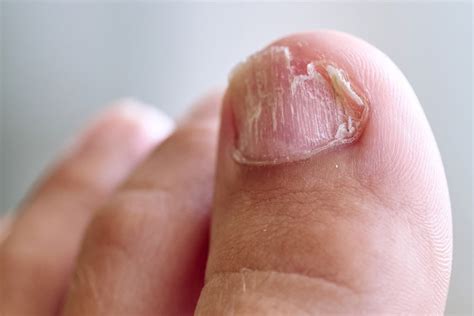 How to Get Rid of Fungus from Acrylic Nails? | Foot + Ankle Specialty