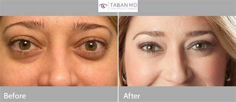 Thyroid Eye Disease Surgery Graves Eye Disease Surger - vrogue.co